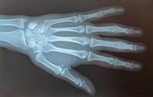 An X-ray image of a hand and wrist.