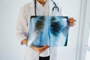 A doctor with a stethoscope around his neck holding an x-ray image of ribs.