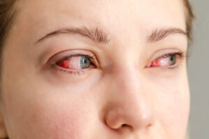 A woman looking away with red irritated eyes