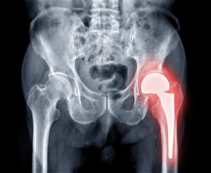 An X-ray image of a broken pelvic bone.